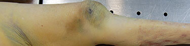 Unexplained bruising elderly