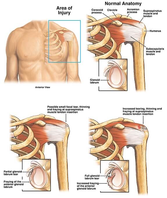 rotator cuff tear car accident settlement